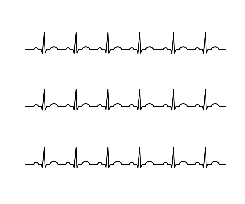 AEDが必要ない正常な心電図